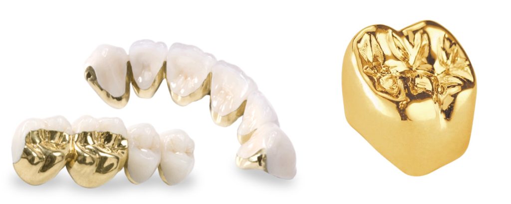 Crown & Bridge Dental Lab All-Ceramic – PFM – Full Cast