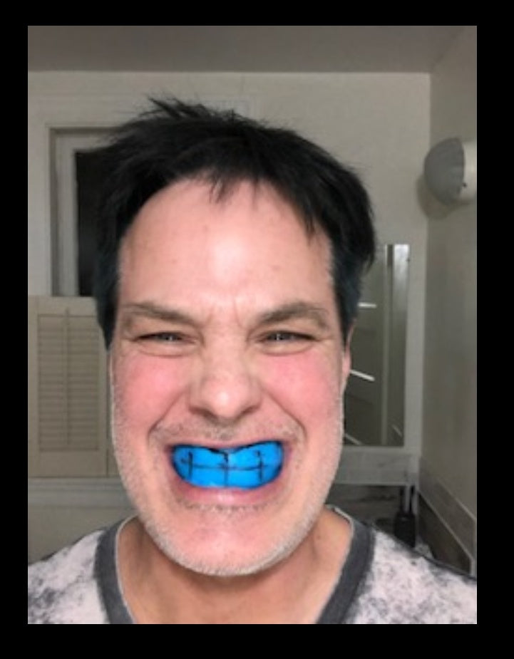 Custom-Fit UPPER AND LOWER COMPLETE DENTURE (FULL ACRYLIC SET)