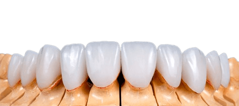 Crown & Bridge Dental Lab All-Ceramic – PFM – Full Cast